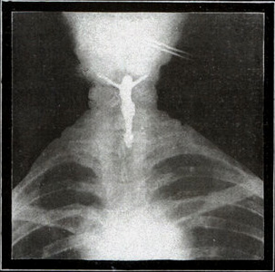 An Xray of a Crucifix in a Woman's Throat